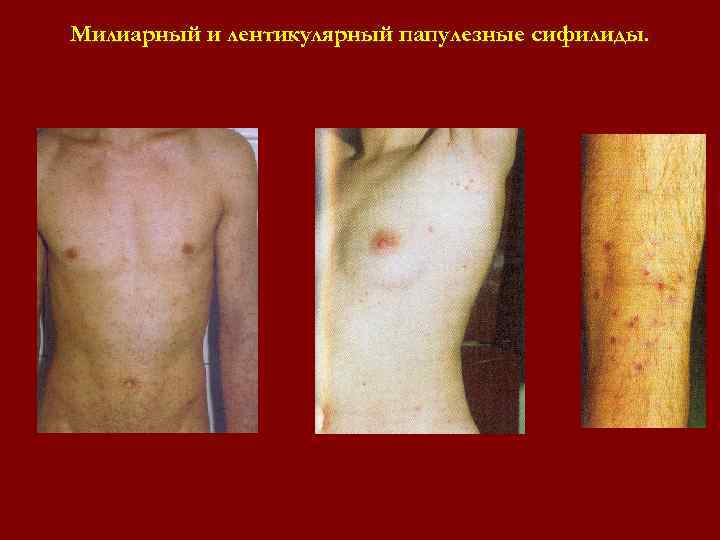 Милиарный и лентикулярный папулезные сифилиды. Милиарный и лентикулярный папулезные сифилиды.