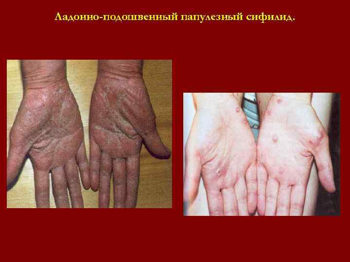 Ладонно-подошвенный папулезный сифилид. Ладонно-подошвенный папулезный сифилид.