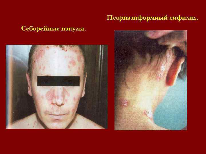 Псориазиформный сифилид. Себорейные папулы. Псориазиформный сифилид. Себорейные папулы.