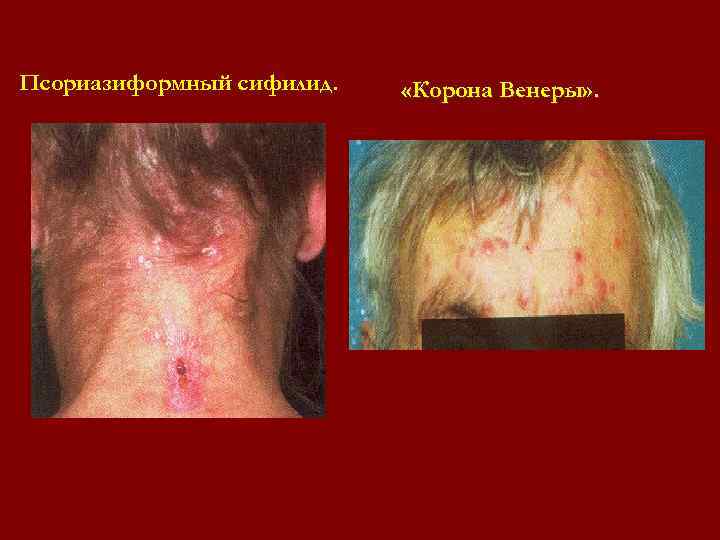 Псориазиформный сифилид. «Корона Венеры» . Псориазиформный сифилид. «Корона Венеры» .