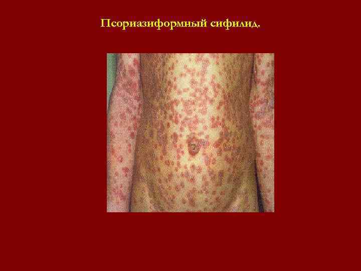 Псориазиформный сифилид. Псориазиформный сифилид.