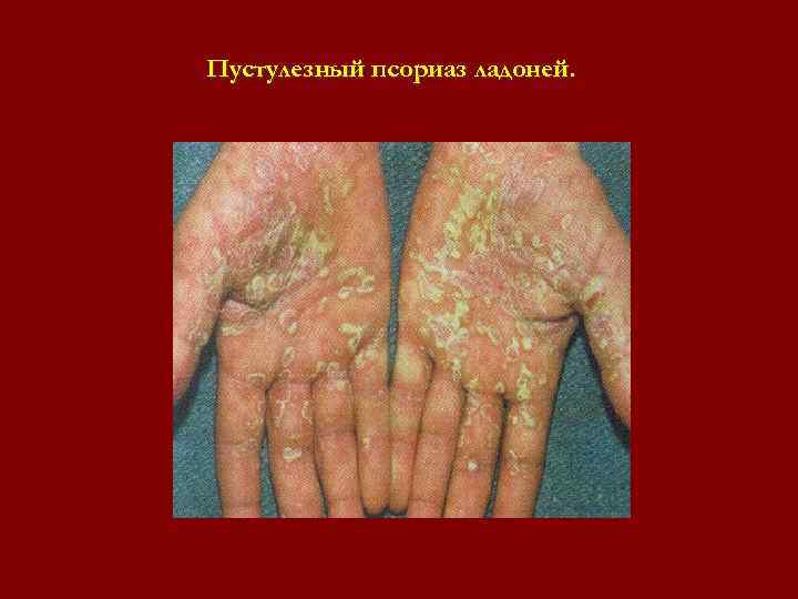 Пустулезный псориаз ладоней. Пустулезный псориаз ладоней.