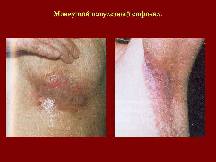 Мокнущий папулезный сифилид. Мокнущий папулезный сифилид.