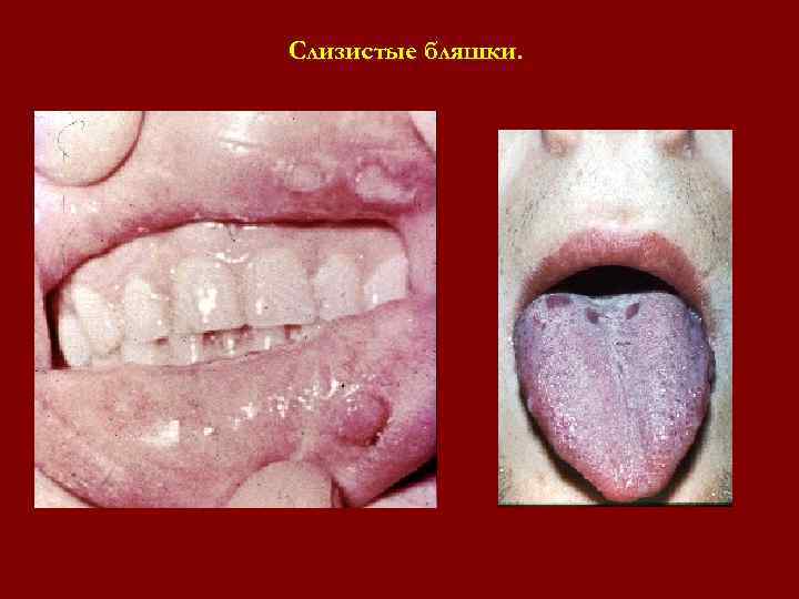 Слизистые бляшки. Слизистые бляшки.