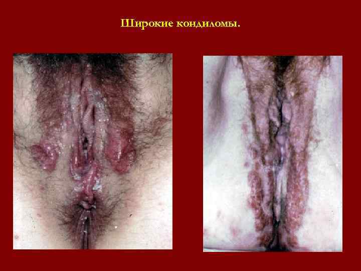 Широкие кондиломы. Широкие кондиломы.