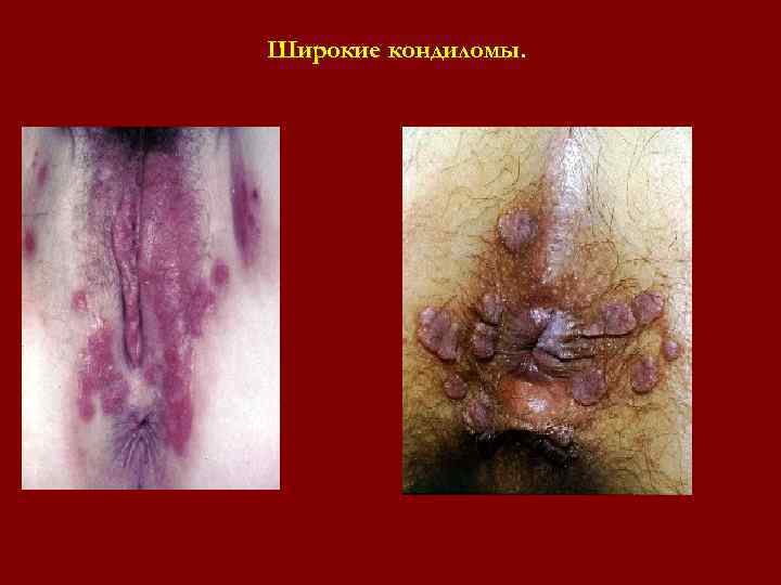 Широкие кондиломы. Широкие кондиломы.