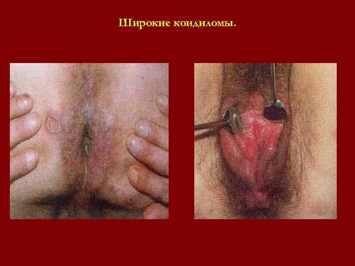 Широкие кондиломы. Широкие кондиломы.