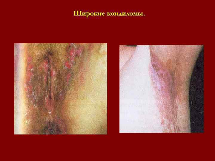 Широкие кондиломы. Широкие кондиломы.