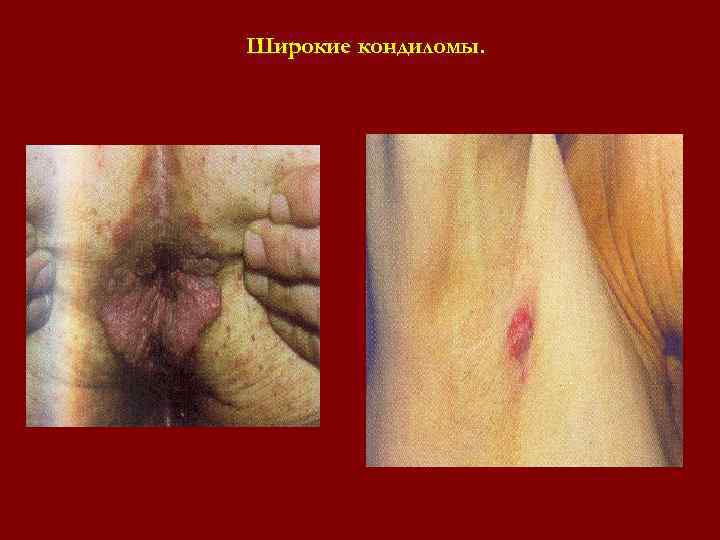 Широкие кондиломы. Широкие кондиломы.