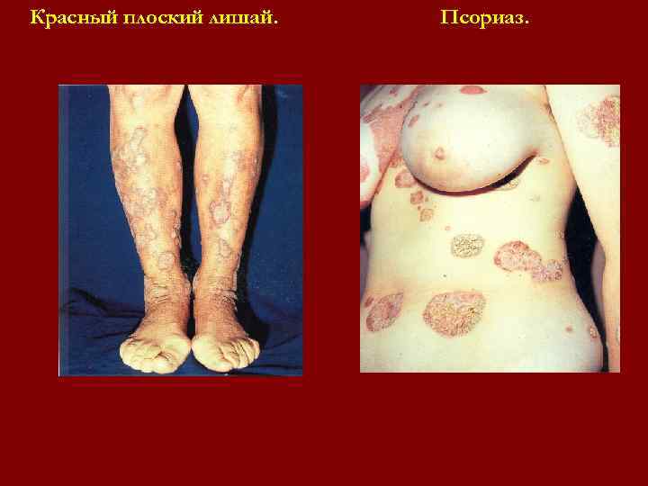Красный плоский лишай. Псориаз. Красный плоский лишай. Псориаз.