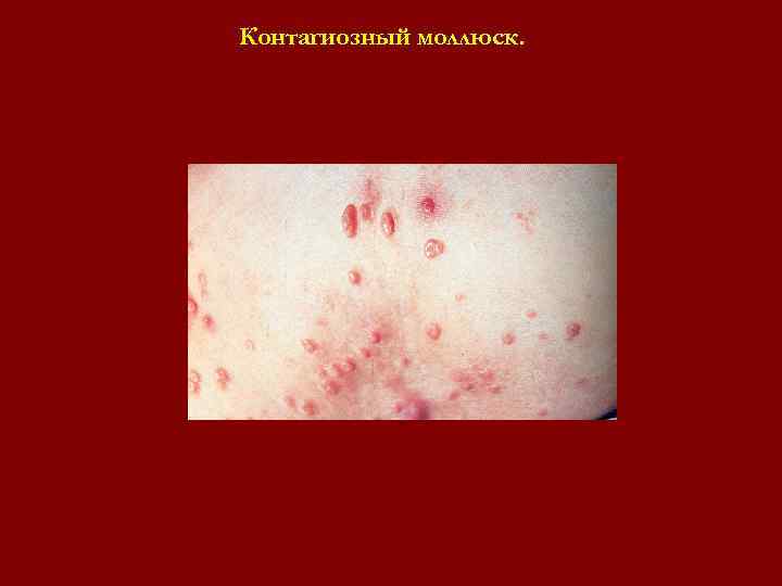 Контагиозный моллюск. Контагиозный моллюск.