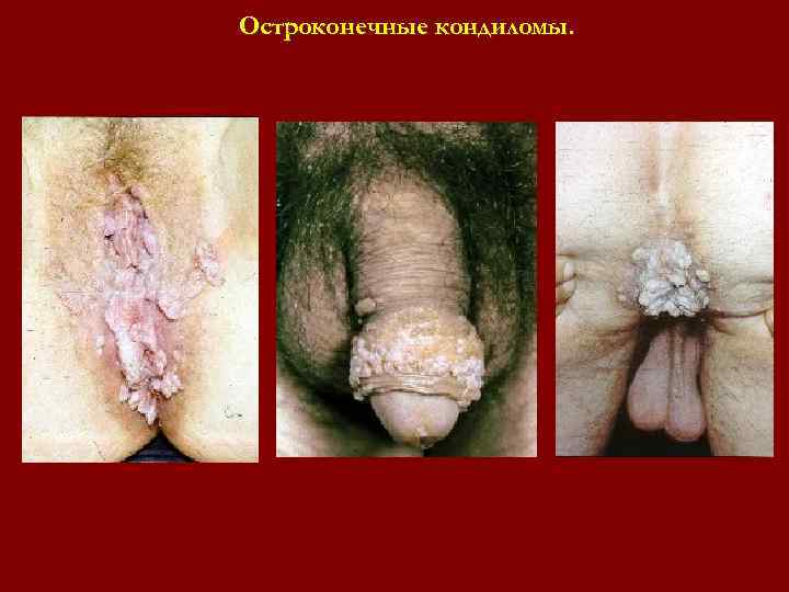 Остроконечные кондиломы. Остроконечные кондиломы.