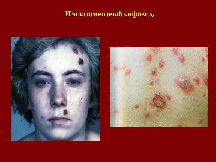 Импетигинозный сифилид. Импетигинозный сифилид.
