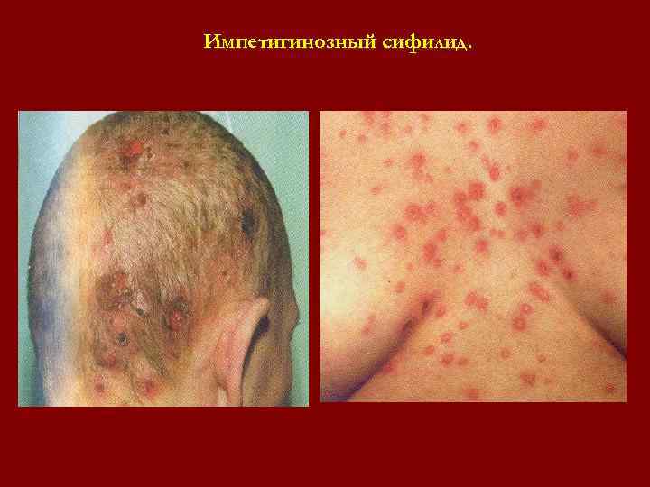 Импетигинозный сифилид. Импетигинозный сифилид.