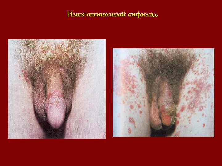 Импетигинозный сифилид. Импетигинозный сифилид.