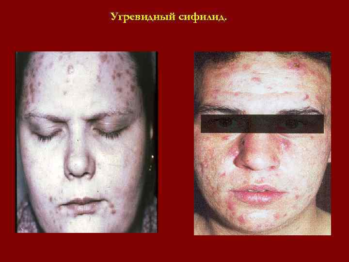 Угревидный сифилид. Угревидный сифилид.