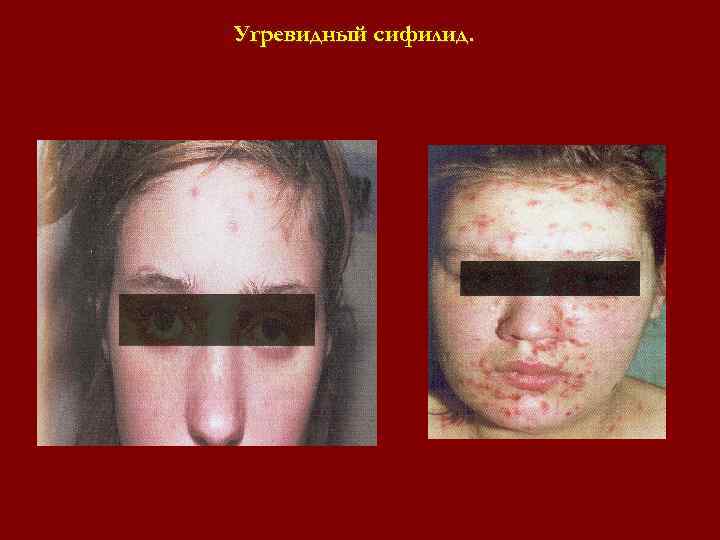 Угревидный сифилид. Угревидный сифилид.