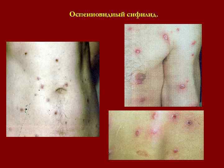Оспенновидный сифилид. Оспенновидный сифилид.