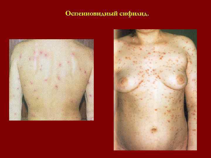 Оспенновидный сифилид. Оспенновидный сифилид.