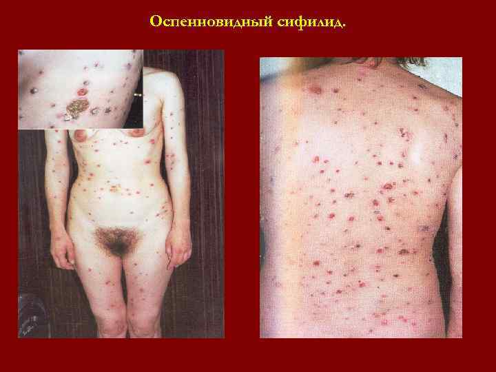 Оспенновидный сифилид. Оспенновидный сифилид.