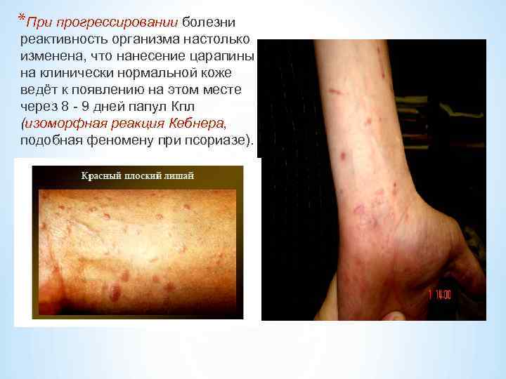 *При прогрессировании болезни реактивность организма настолько изменена, что нанесение царапины на клинически нормальной коже