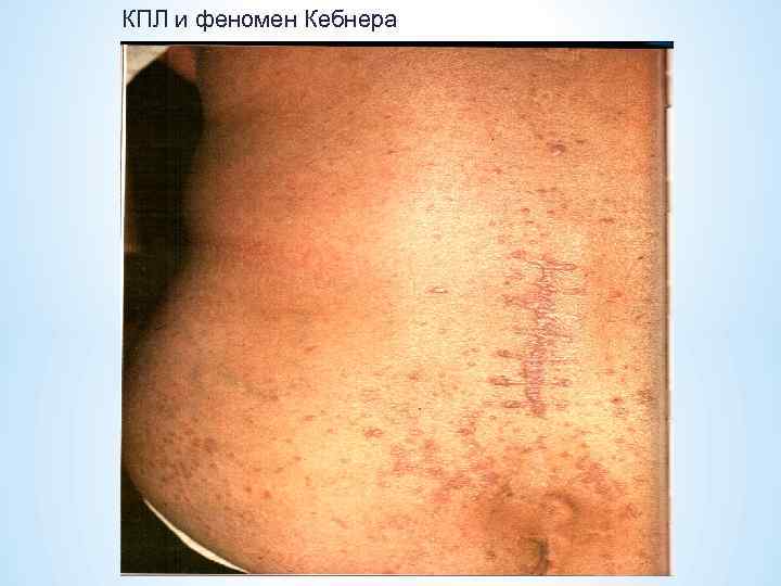 КПЛ и феномен Кебнера 