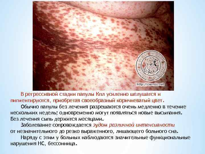   В регрессивной стадии папулы Кпл усиленно шелушатся и пигментируются, приобретая своеобразный коричневатый