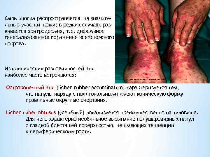 Сыпь иногда распространяется на значите- льные участки кожи; в редких случаях раз- вивается эритродермия,
