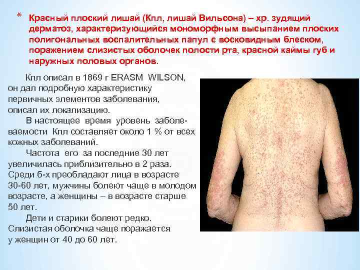  *  Красный плоский лишай (Кпл, лишай Вильсона) – хр. зудящий дерматоз, характеризующийся