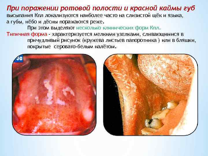 При поражении ротовой полости и красной каймы губ высыпания Кпл локализуются наиболее часто на