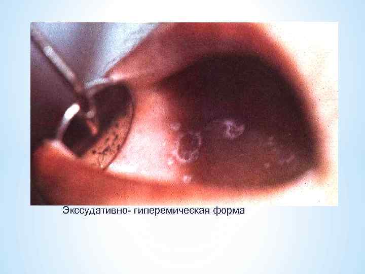 Экссудативно- гиперемическая форма 