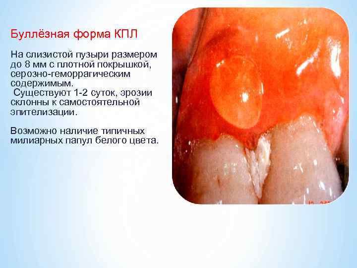 Буллёзная форма КПЛ На слизистой пузыри размером до 8 мм с плотной покрышкой, серозно-геморрагическим