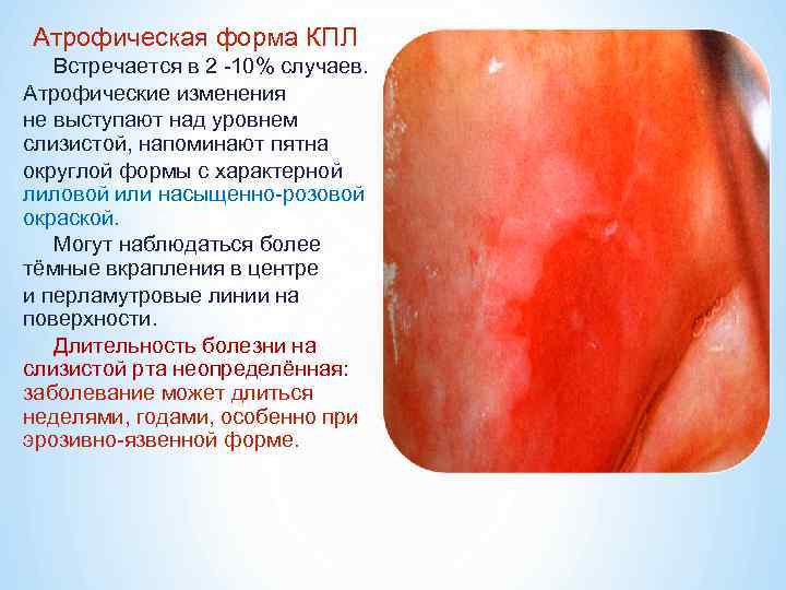 Атрофическая форма КПЛ  Встречается в 2 -10% случаев. Атрофические изменения не выступают над