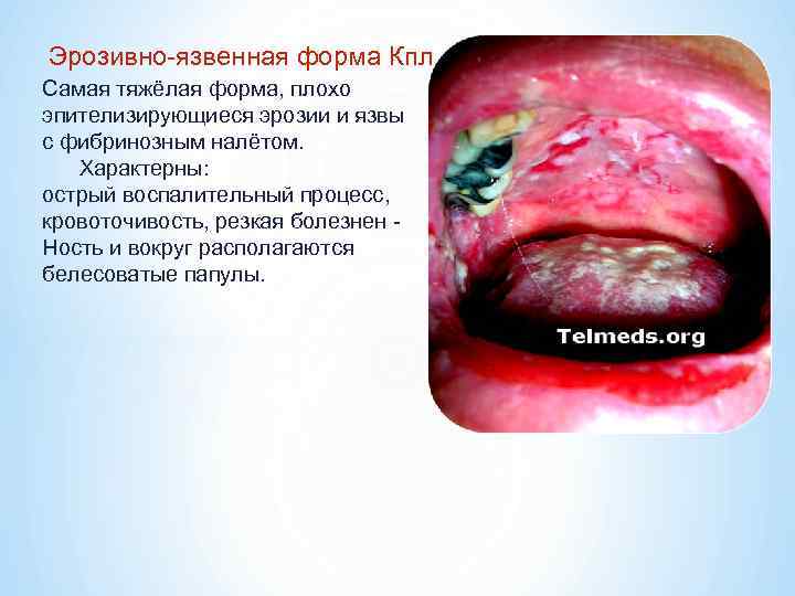 Эрозивно-язвенная форма Кпл. Самая тяжёлая форма, плохо эпителизирующиеся эрозии и язвы с фибринозным налётом.