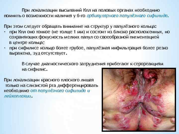   При локализации высыпаний Кпл на половых органах необходимо помнить о возможности наличия