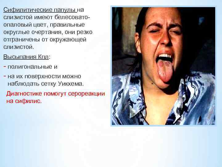 Сифилитические папулы на слизистой имеют белесовато- опаловый цвет, правильные округлые очертания, они резко отграничены