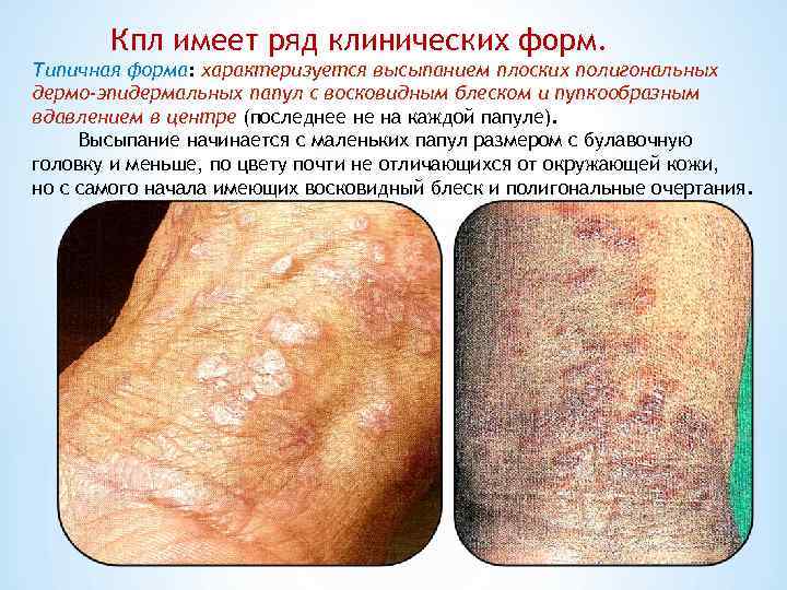   Кпл имеет ряд клинических форм. Типичная форма: характеризуется высыпанием плоских полигональных дермо-эпидермальных