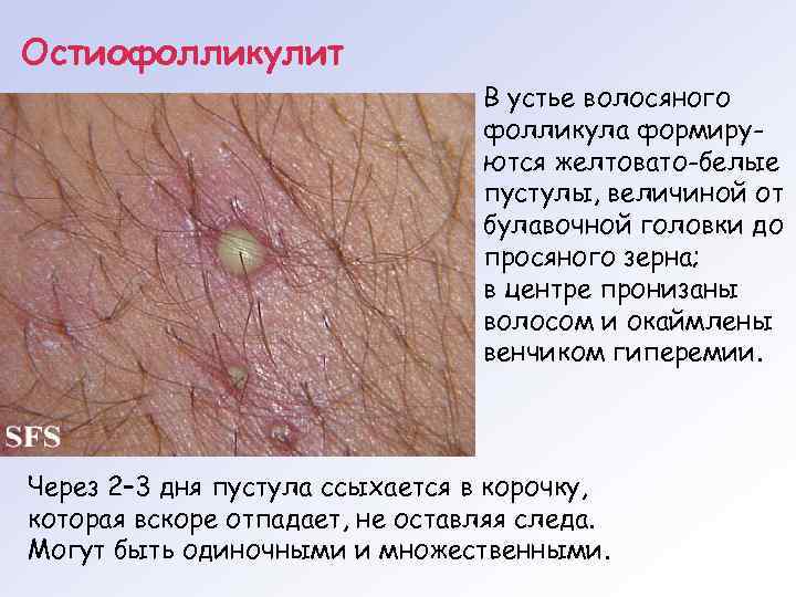 Остиофолликулит       В устье волосяного    