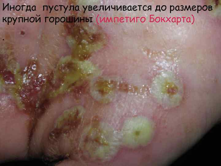 Иногда пустула увеличивается до размеров крупной горошины (импетиго Бокхарта). 