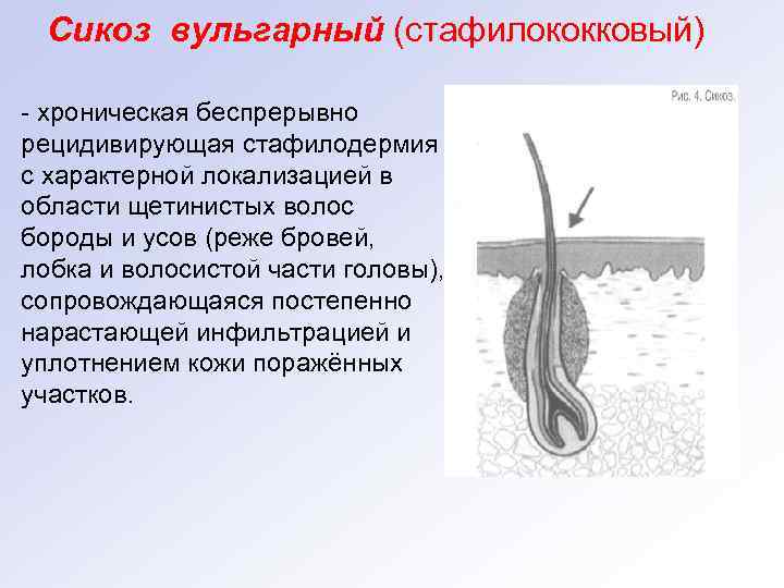  Сикоз вульгарный (стафилококковый) - хроническая беспрерывно рецидивирующая стафилодермия с характерной локализацией в области