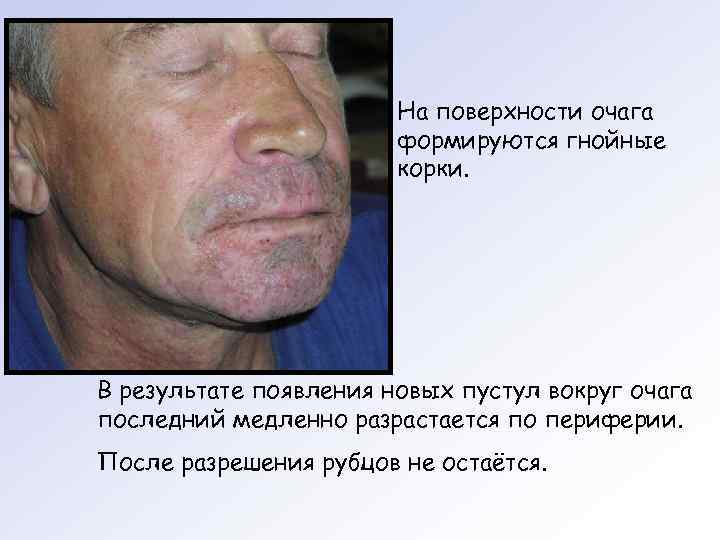     На поверхности очага     формируются гнойные 