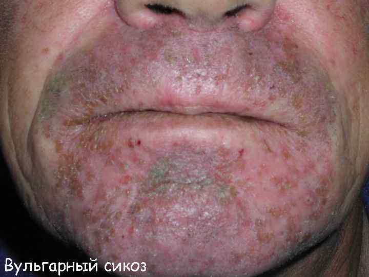 Вульгарный сикоз 