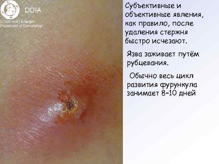 Субъективные и объективные явления, как правило, после удаления стержня быстро исчезают. Язва заживает путём