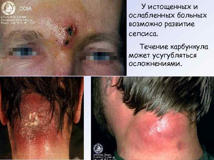   У истощенных и ослабленных больных возможно развитие сепсиса. Течение карбункула может усугубляться