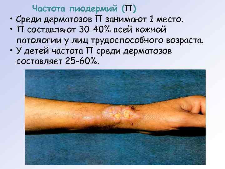  Частота пиодермий (П) • Среди дерматозов П занимают 1 место.  • П