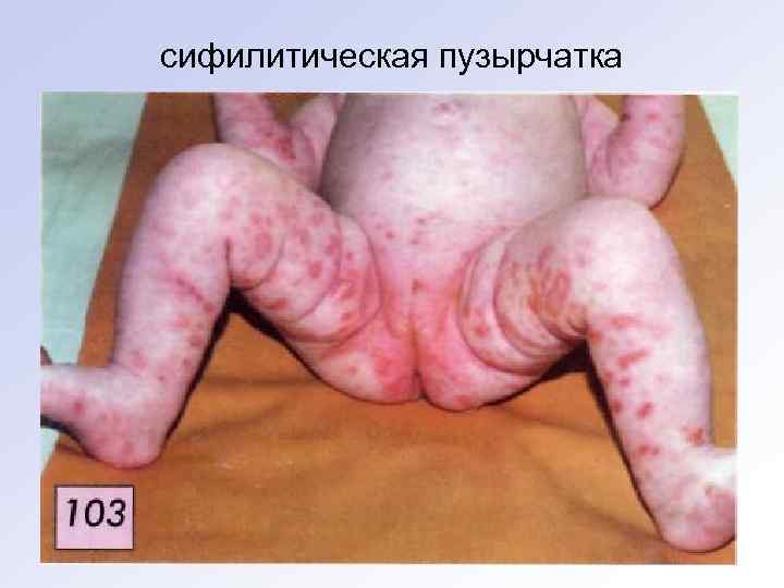 сифилитическая пузырчатка 