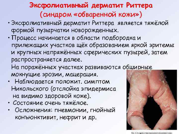  Эксфолиативный дерматит Риттера   (синдром «обваренной кожи» ) • Эксфолиативный дерматит Риттера