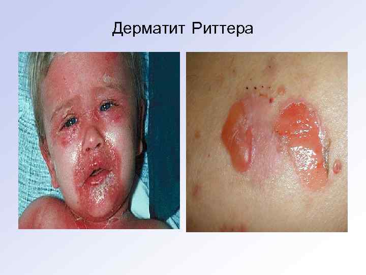 Дерматит Риттера 