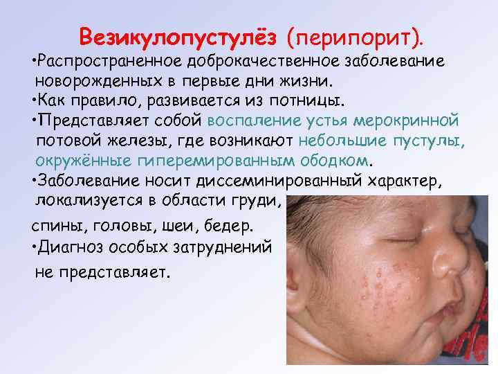  Везикулопустулёз (перипорит).  • Распространенное доброкачественное заболевание новорожденных в первые дни жизни. 