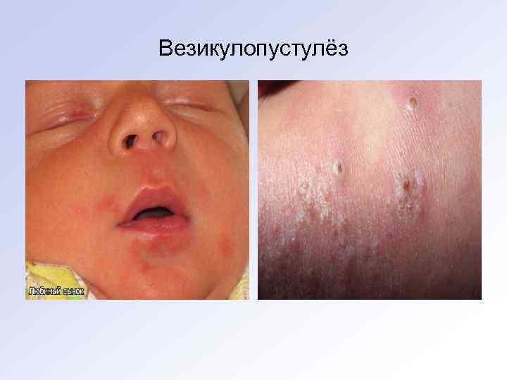 Везикулопустулёз 